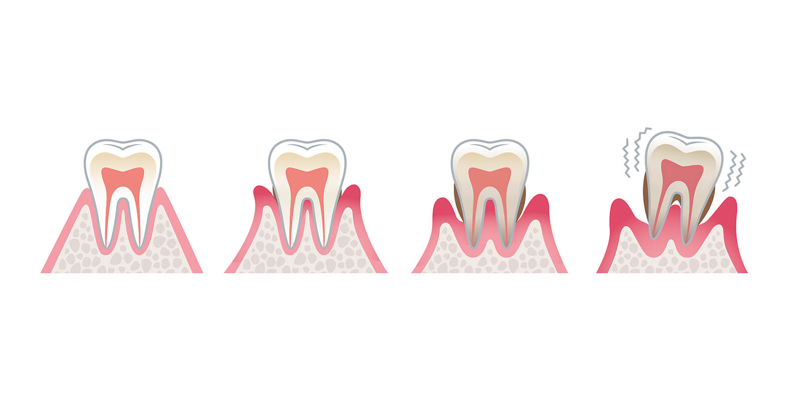 歯周病症状の段階について